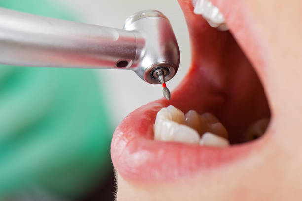 Best Emergency Root Canal Treatment in Winters, TX